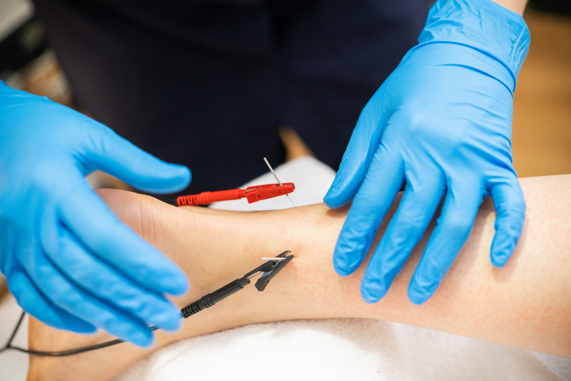 electro-acupuncture-dry-with-needle-connecting-mac-2023-11-27-05-00-46-utc