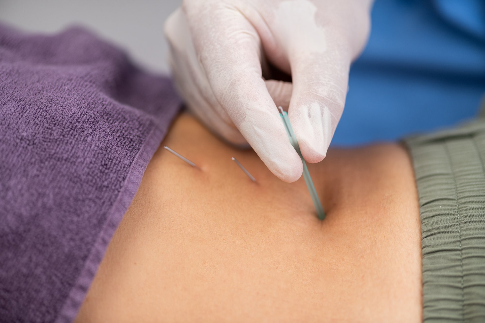 physical-therapist-performing-dry-needling-on-a-pa-2024-12-03-22-24-22-utc