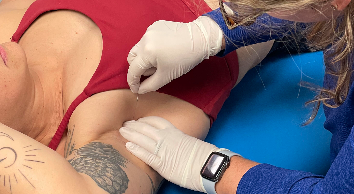 CoreMovement+Physical+Therapy+-+dry+needling+patient